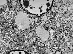 M, | newborn mitochondrial cardiomyopathy … autopsy sample from liver